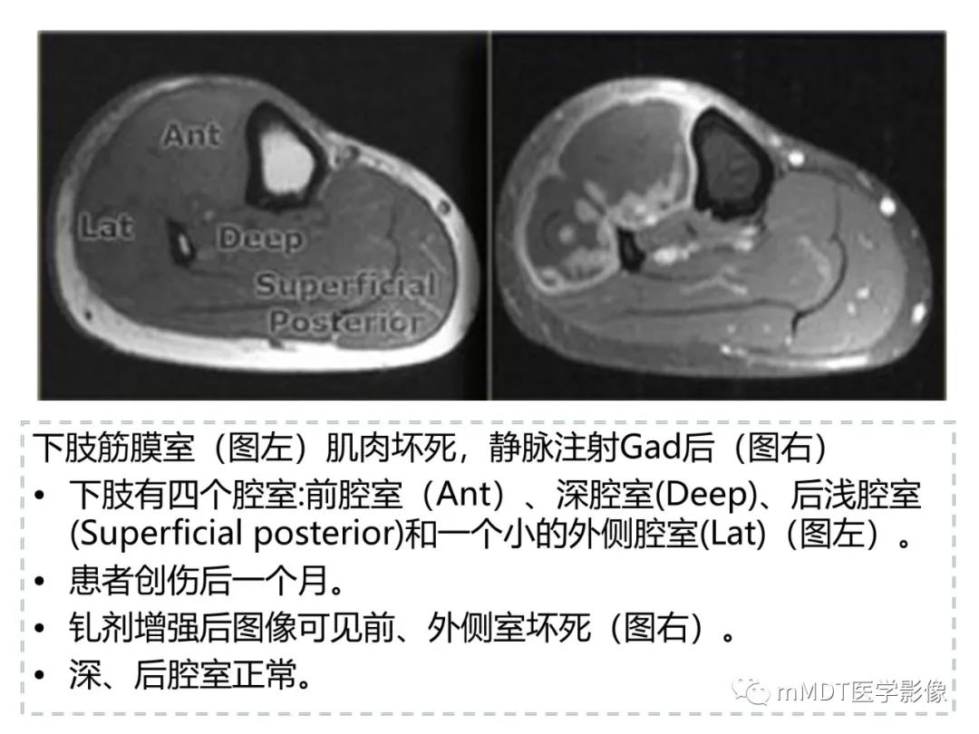 影像PPT - 【PPT】肌肉MR-创伤性异常-41 影像PPT - 【PPT】肌肉MR-创伤性异常-41