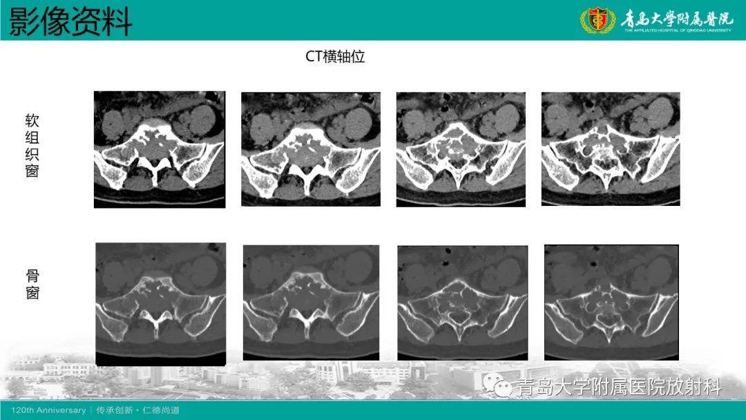 影像PPT - 【病例】骶椎椎体血管瘤1例CT及MR影像-4