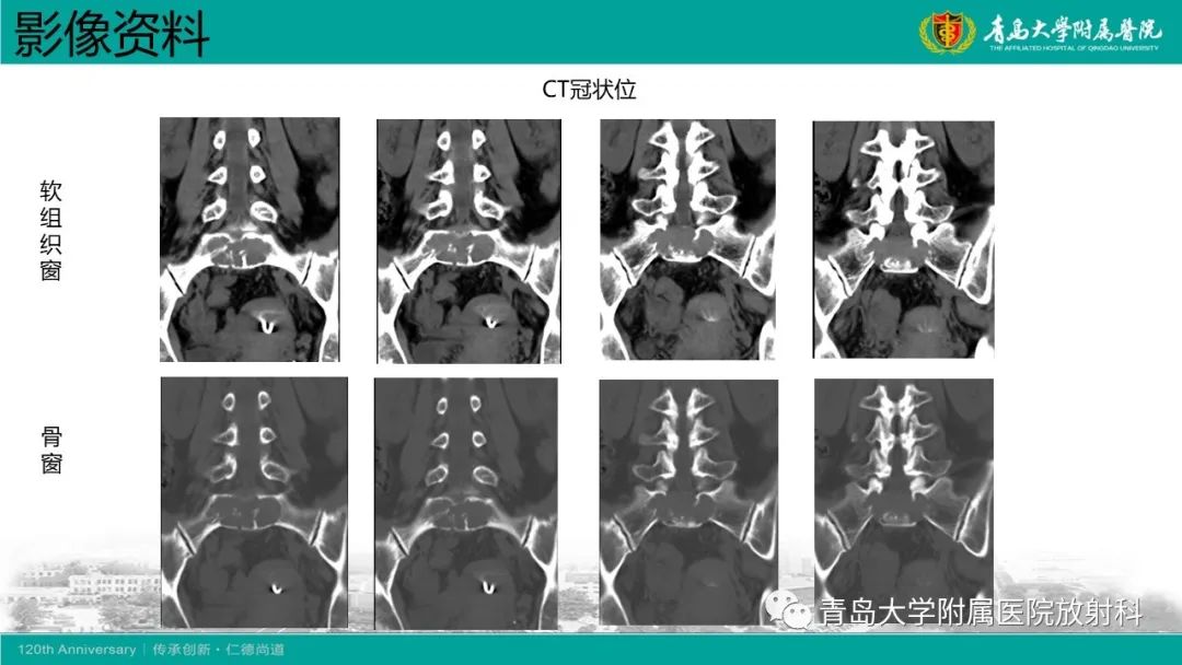 影像PPT - 【病例】骶椎椎体血管瘤1例CT及MR影像-6