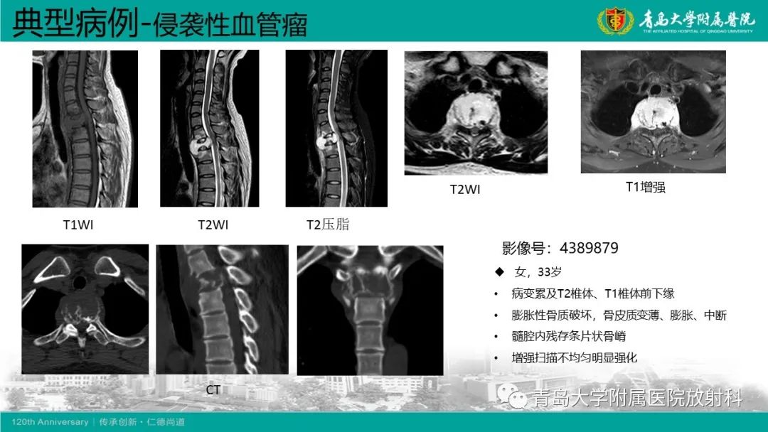 影像PPT - 【病例】骶椎椎体血管瘤1例CT及MR影像-20