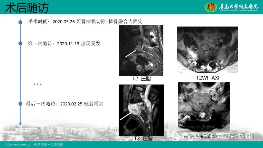 影像PPT - 【病例】骶椎椎体血管瘤1例CT及MR影像-29