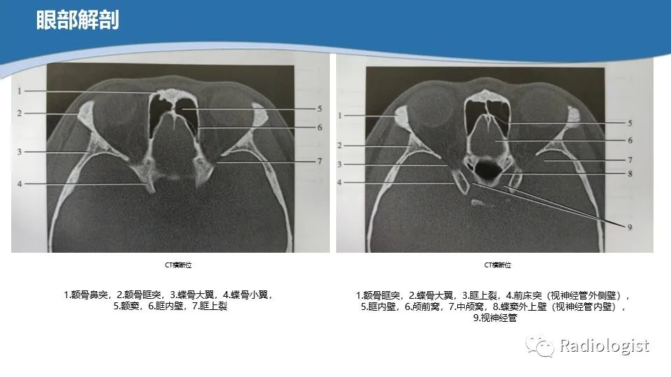 影像PPT - 【PPT】眼部疾病CT、MRI影像表现-4