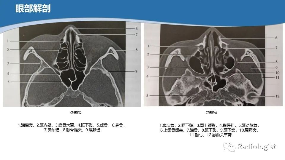 影像PPT - 【PPT】眼部疾病CT、MRI影像表现-5