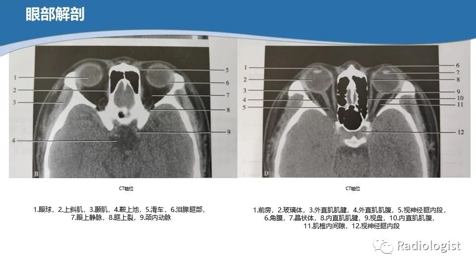 影像PPT - 【PPT】眼部疾病CT、MRI影像表现-8