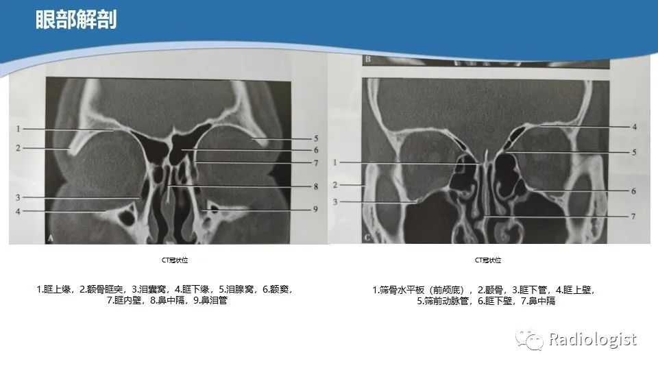 影像PPT - 【PPT】眼部疾病CT、MRI影像表现-6