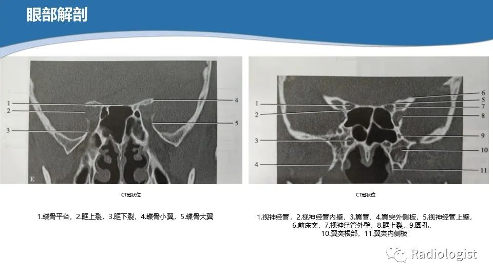 影像PPT - 【PPT】眼部疾病CT、MRI影像表现-7