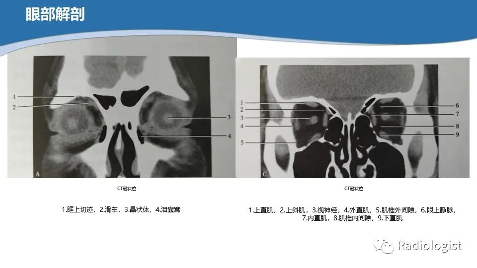影像PPT - 【PPT】眼部疾病CT、MRI影像表现-9