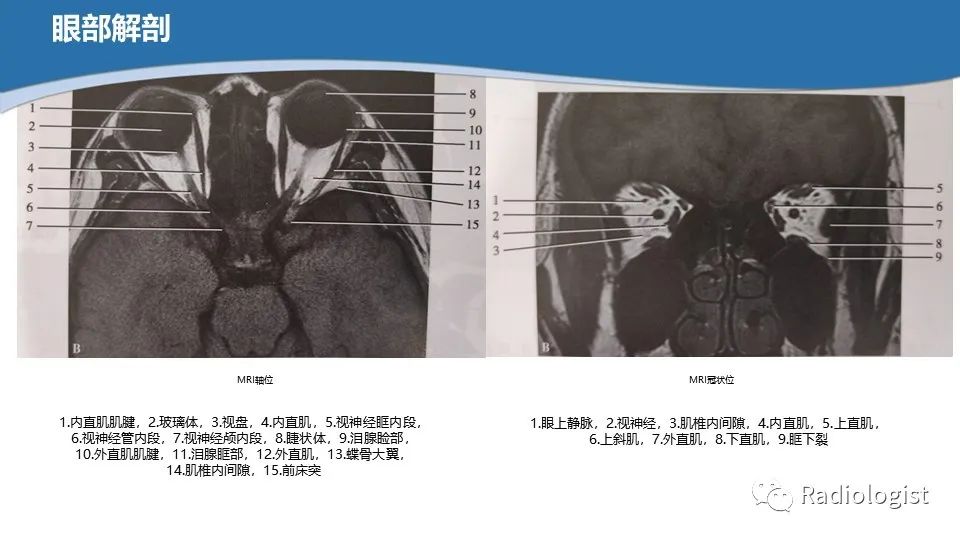 影像PPT - 【PPT】眼部疾病CT、MRI影像表现-10