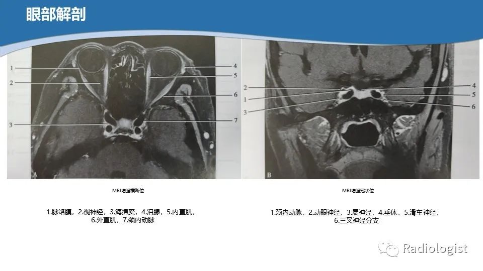 影像PPT - 【PPT】眼部疾病CT、MRI影像表现-12