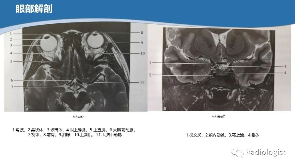 影像PPT - 【PPT】眼部疾病CT、MRI影像表现-11