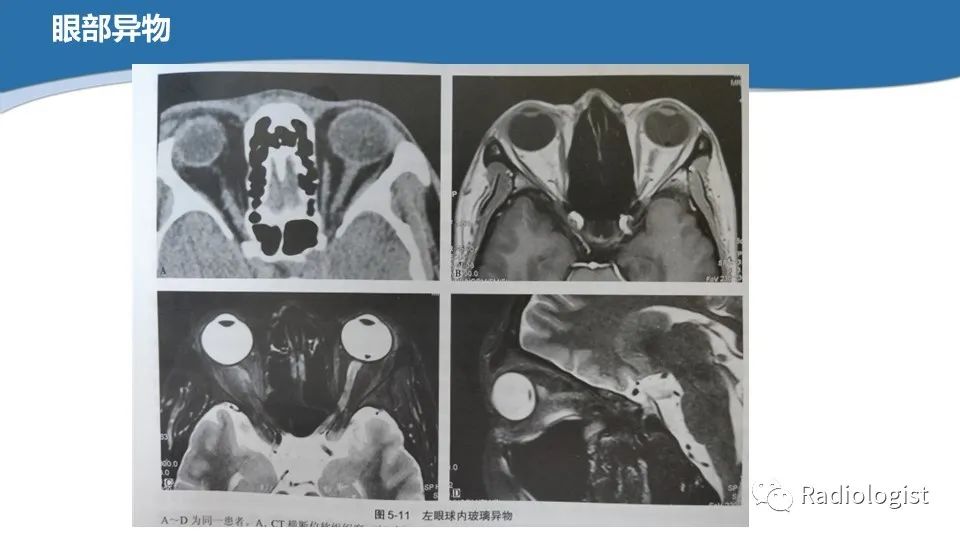 影像PPT - 【PPT】眼部疾病CT、MRI影像表现-19