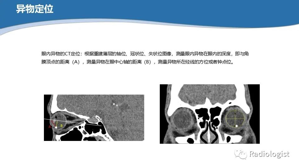 影像PPT - 【PPT】眼部疾病CT、MRI影像表现-21