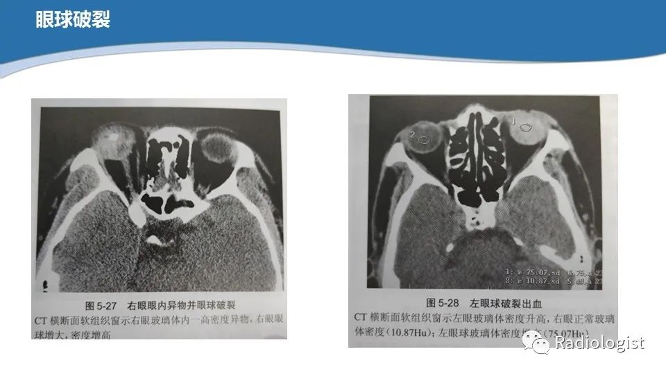 影像PPT - 【PPT】眼部疾病CT、MRI影像表现-25