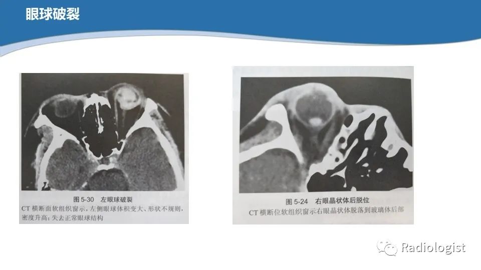 影像PPT - 【PPT】眼部疾病CT、MRI影像表现-26