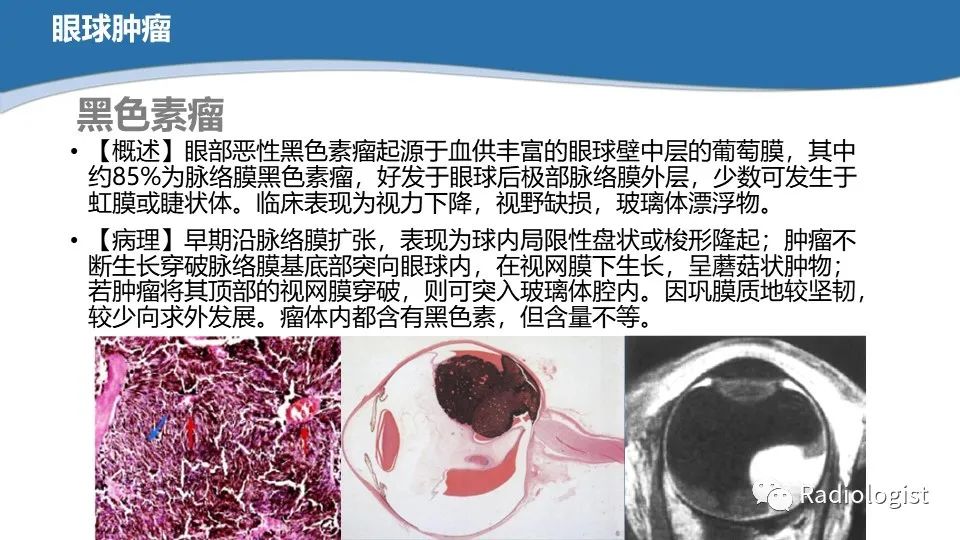 影像PPT - 【PPT】眼部疾病CT、MRI影像表现-38