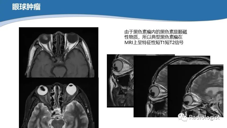 影像PPT - 【PPT】眼部疾病CT、MRI影像表现-39