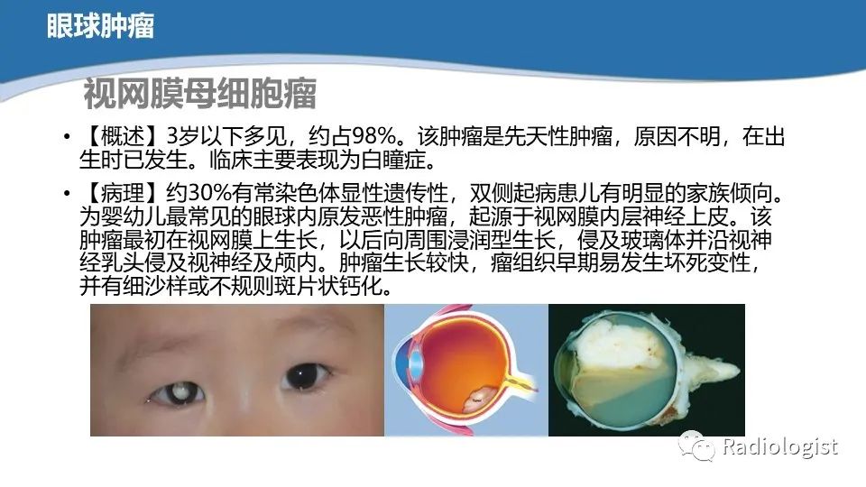 影像PPT - 【PPT】眼部疾病CT、MRI影像表现-42