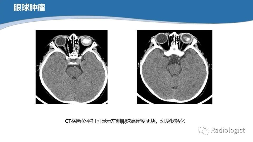 影像PPT - 【PPT】眼部疾病CT、MRI影像表现-43