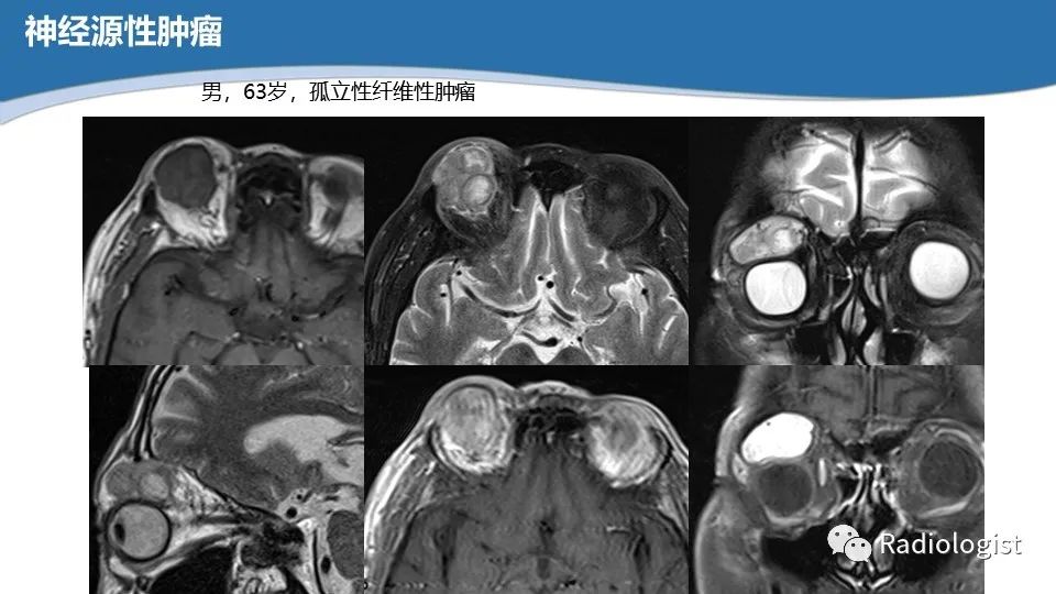 影像PPT - 【PPT】眼部疾病CT、MRI影像表现-56