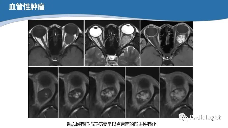 影像PPT - 【PPT】眼部疾病CT、MRI影像表现-60