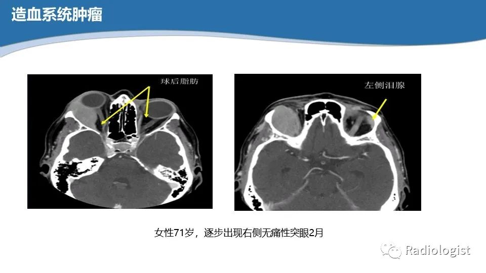 影像PPT - 【PPT】眼部疾病CT、MRI影像表现-73