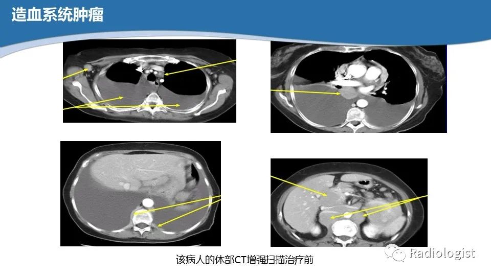 影像PPT - 【PPT】眼部疾病CT、MRI影像表现-74