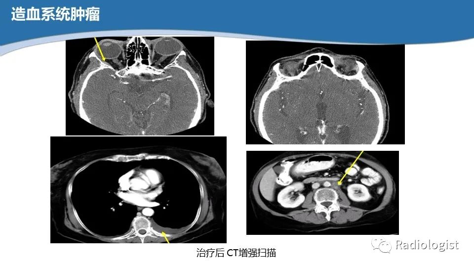 影像PPT - 【PPT】眼部疾病CT、MRI影像表现-75