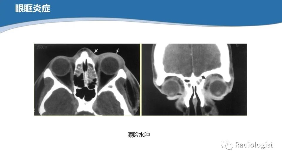 影像PPT - 【PPT】眼部疾病CT、MRI影像表现-79