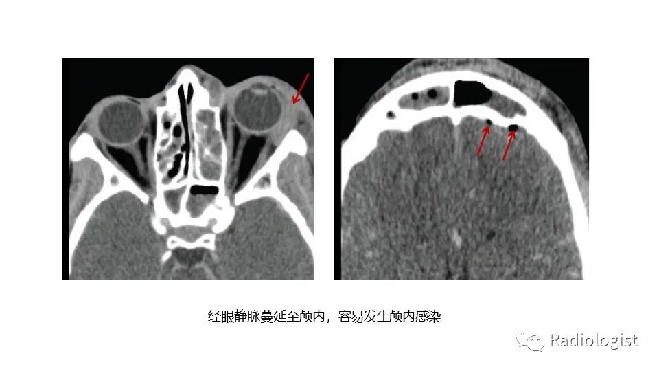 影像PPT - 【PPT】眼部疾病CT、MRI影像表现-80