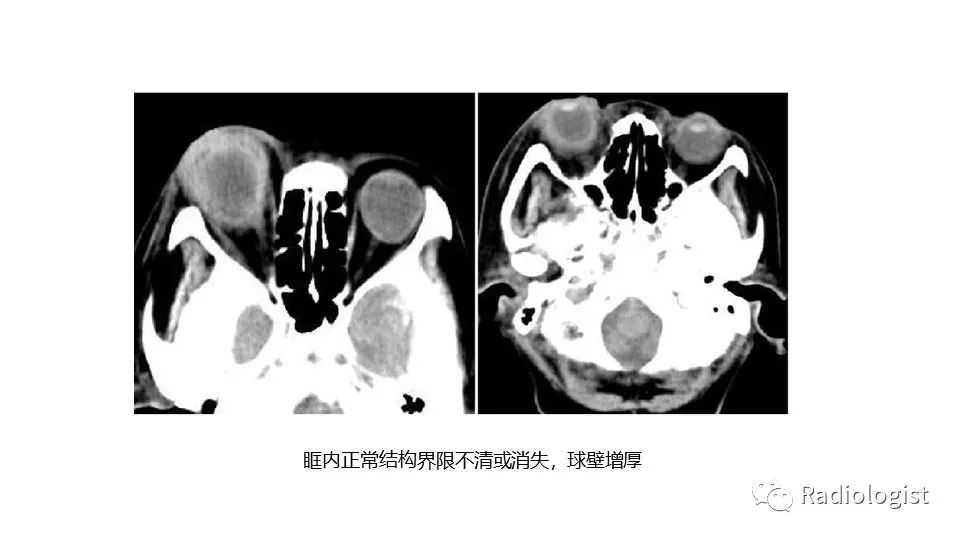 影像PPT - 【PPT】眼部疾病CT、MRI影像表现-81
