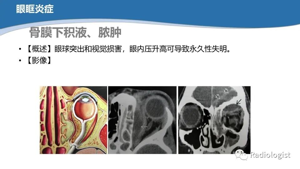 影像PPT - 【PPT】眼部疾病CT、MRI影像表现-82