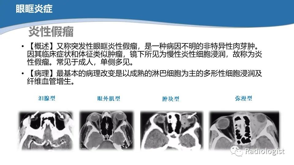 影像PPT - 【PPT】眼部疾病CT、MRI影像表现-84