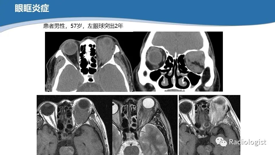 影像PPT - 【PPT】眼部疾病CT、MRI影像表现-85