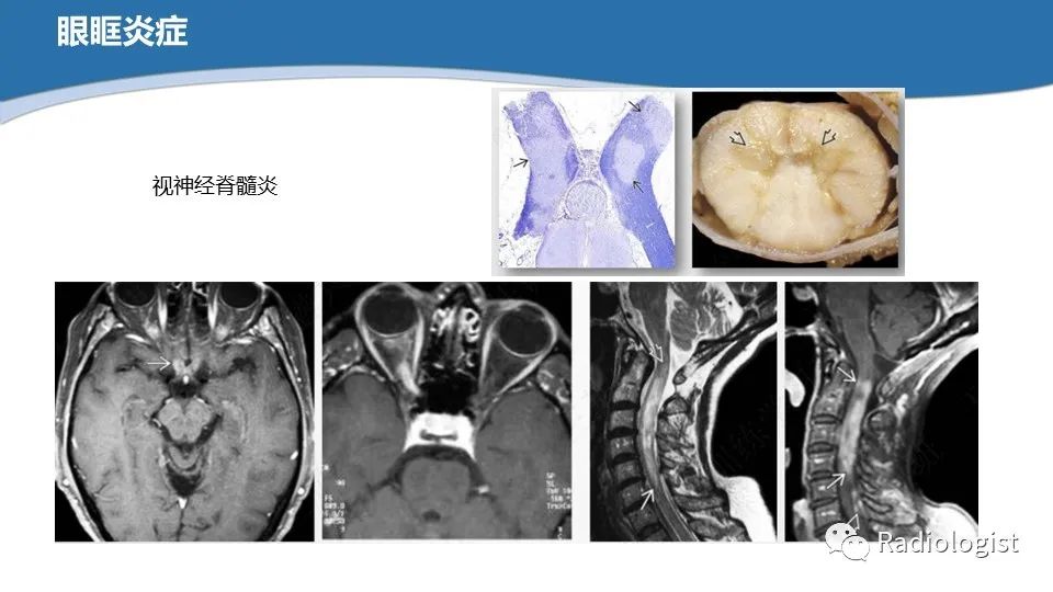 影像PPT - 【PPT】眼部疾病CT、MRI影像表现-96