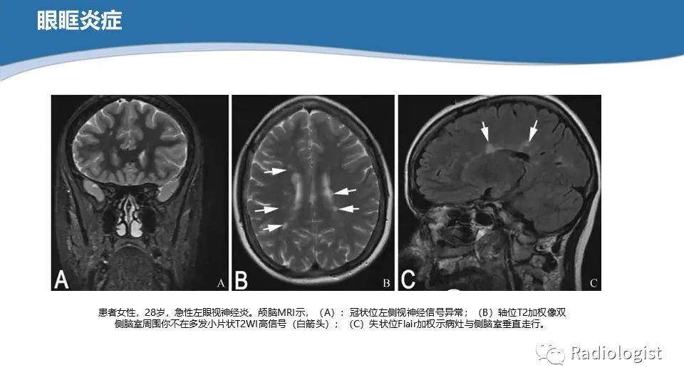 影像PPT - 【PPT】眼部疾病CT、MRI影像表现-97