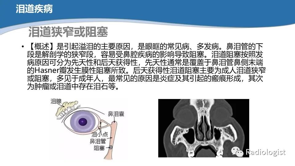 影像PPT - 【PPT】眼部疾病CT、MRI影像表现-99