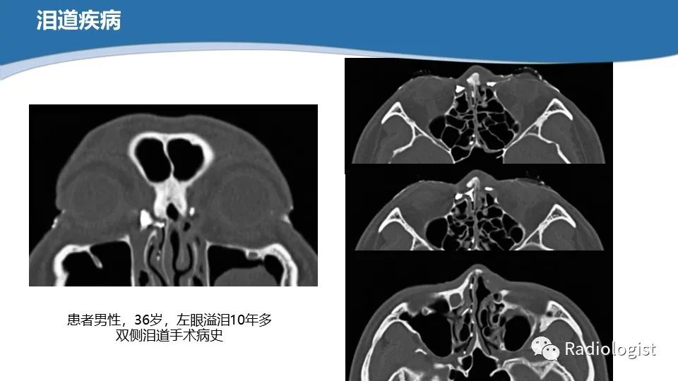 影像PPT - 【PPT】眼部疾病CT、MRI影像表现-101