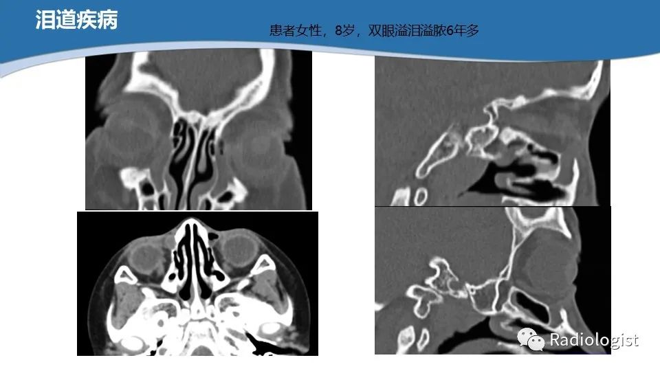 影像PPT - 【PPT】眼部疾病CT、MRI影像表现-103