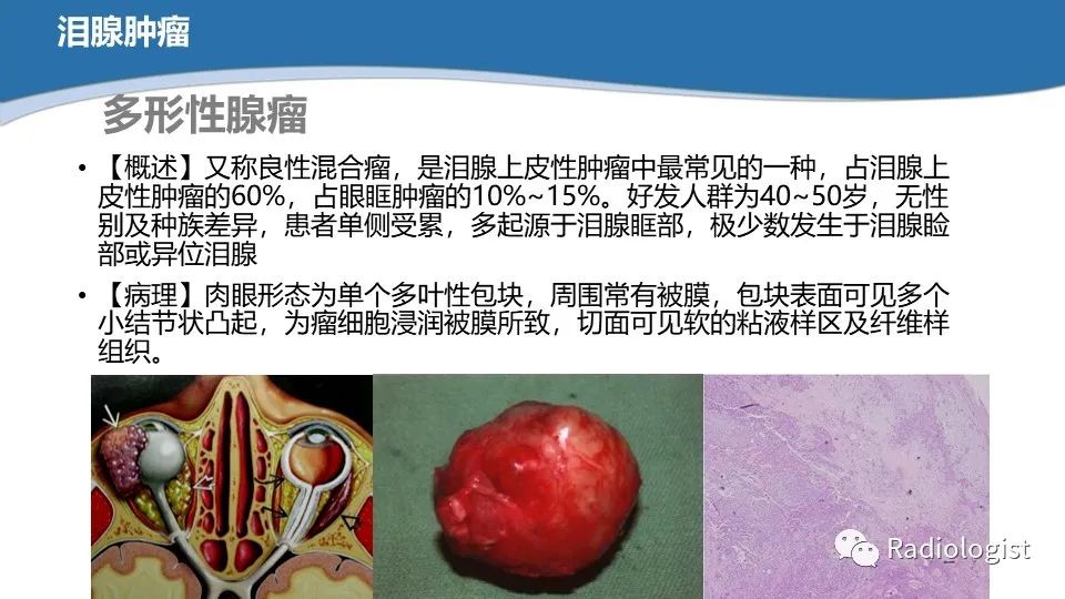 影像PPT - 【PPT】眼部疾病CT、MRI影像表现-104