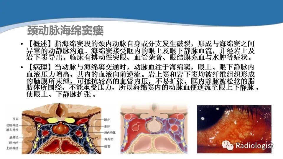 影像PPT - 【PPT】眼部疾病CT、MRI影像表现-110