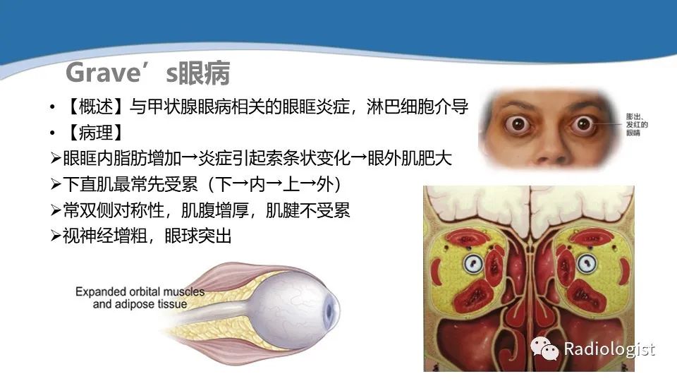 影像PPT - 【PPT】眼部疾病CT、MRI影像表现-114