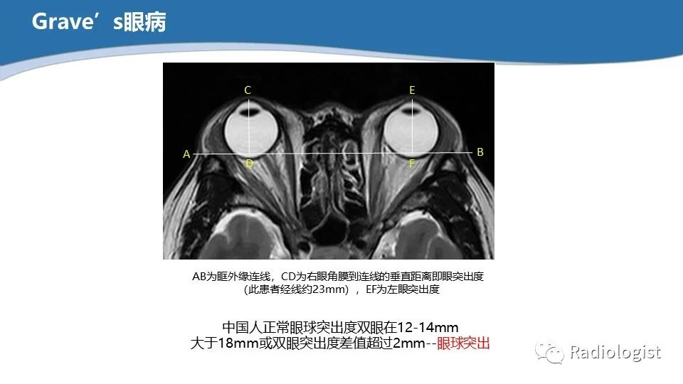 影像PPT - 【PPT】眼部疾病CT、MRI影像表现-115