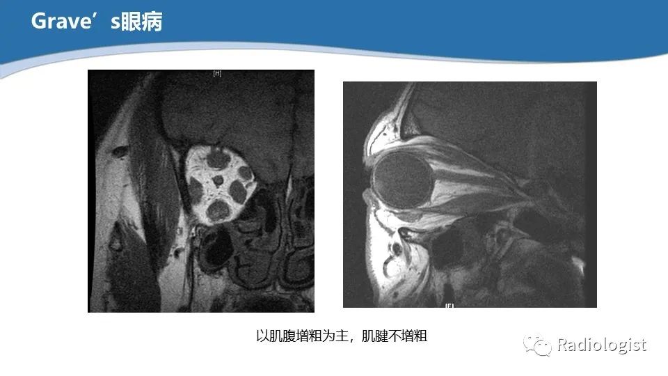 影像PPT - 【PPT】眼部疾病CT、MRI影像表现-116