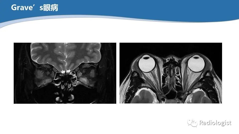 影像PPT - 【PPT】眼部疾病CT、MRI影像表现-117