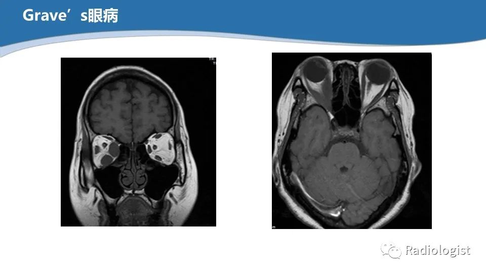 影像PPT - 【PPT】眼部疾病CT、MRI影像表现-118
