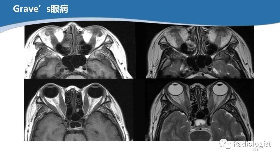 影像PPT - 【PPT】眼部疾病CT、MRI影像表现-120