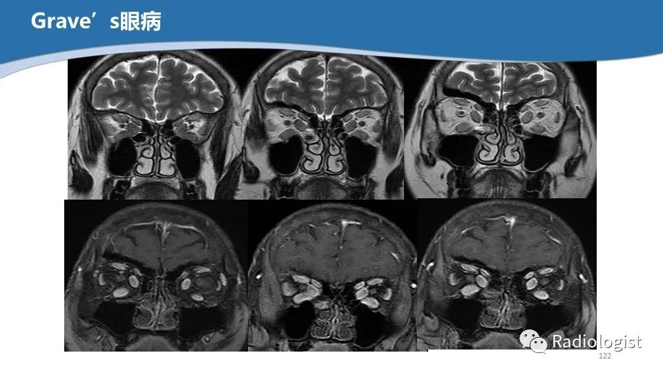 影像PPT - 【PPT】眼部疾病CT、MRI影像表现-121