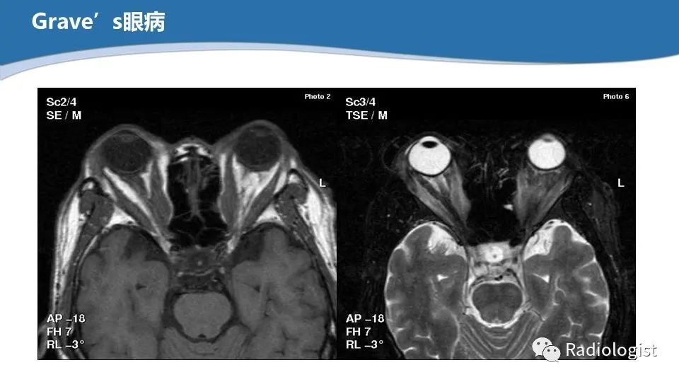影像PPT - 【PPT】眼部疾病CT、MRI影像表现-122