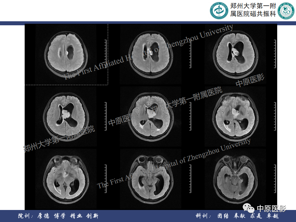 影像PPT - 【病例】侧脑室胶质母细胞瘤1例MR影像-5
