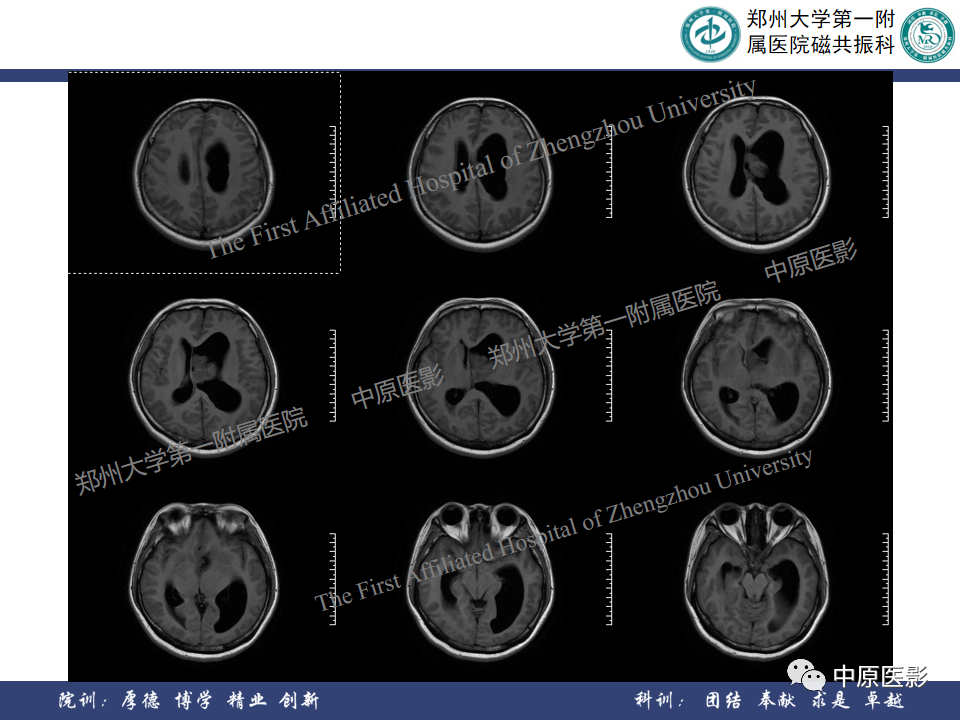 影像PPT - 【病例】侧脑室胶质母细胞瘤1例MR影像-4